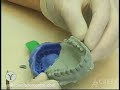 Porcelain Veneer & Crown Technology w/ Yaletown Dental