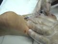 Botox Procedure for Plantar Hyperhidrosis Botox Procedure for Plantar Hyperhidrosis
