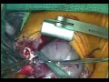 Repair of the Tetralogy of Fallot with Absent Pulmonary Valv