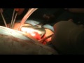 Histerectomía Abdominal- Abdominal Hysterectomy