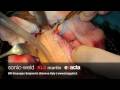 calvaria e rialzo di seno con sonic weld