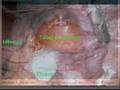IVF- in the beginning