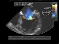 mitral regurgitation
