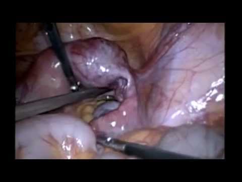 how to cure ectopic pregnancy