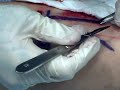 Scarification