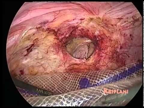 how to repair abdominal fascia