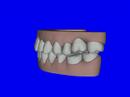 Patien # 1125078 Left Buccal