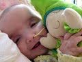 Ainsley was born via c-section for a difficult presentation at full term. She had stridor at birth due to an unknown cause and was intubated. Three extubation attempts failed and she was given a tracheostomy at 5 weeks. She has had two cranial reconstructions for sagittal craniosynostosis as well as several other medical conditions. She is a happy girl despite it all. Visit Ainsley's blog @ http://ainsleyrae.blogspot.com