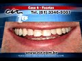 Facetas em resina. Est�tica dent�ria.Cl�nica Odontol�gica CIR - Bras�lia