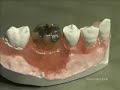 Laser ErYAG et traitement parodontal non chirurgical