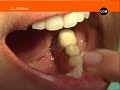 le vendredi 23 mai � 19h30 au journal de lcm pr�sent� par guillaume blardone a diffus� un reportage sur des patients marseillais partis avec yps�e pour leurs implants dentaire en hongrie.