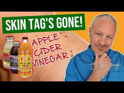 how to remove skin tags at home with vinegar