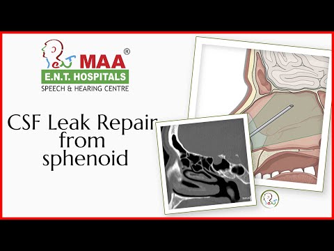 how to fix a csf leak
