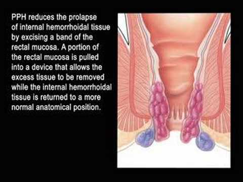 procedure for prolapsing hemorrhoids