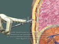 Thoracotomy (normal procedure)