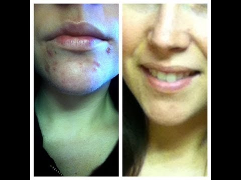 how to help hormonal acne