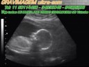 GRAVIMAGEM 52 (ULTRA-SOM GRAVIDEZ 3D 4D 17 SEMANAS) GRAVIMAGEM 52 (ULTRA-SOM GRAVIDEZ 3D 4D 17 SEMANAS)