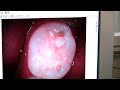 La Dentist, Biolase non surgical gum Treatment