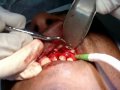Cirugía paraendodóntica 2.wmv