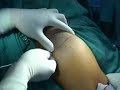 posterior portal shoulder arthroscopy ผ่าตัดหัวไหล่ ปวดไหล่