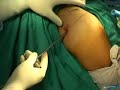 posterior portal shoulder arthroscopy ????????????? ???????