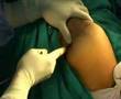 Arthroscopic Placement Of Posterior Shoulder Portal Arthroscopic Placement Of Posterior Shoulder Portal