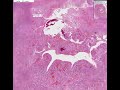 Histopathology Lung --Wegener granulomatosis Wegener's Granulomatosis