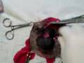 Ablación de tumor en la piel - Hemostasia por ligadura