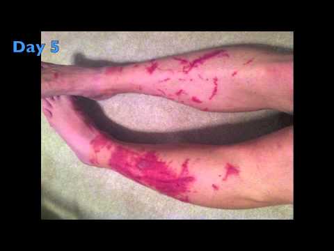 how to relieve poison ivy swelling