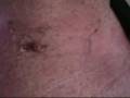 videos de bout a week after my slap tear surgery