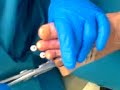 surgical needles out of toes