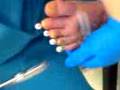 surgical needles out of toes
