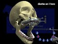 Nobelguide.Teeth in an hour Nobelguide.Teeth in an hour