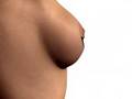 Breast Augmentation with Breast Implants
