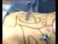 Herzog Laser Center KTVT Dallas Laser Lipo Exclusive