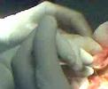 Reemplazo articular de rodilla