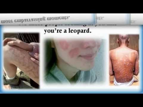 how to cure tinea versicolor