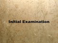 Gynecomastia Surgery: The Journey of Three Men (Highlights) Gynecomastia