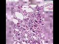 Histopathology Breast --Fat necrosis, traumatic