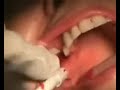 Flap Free Bone Graft I