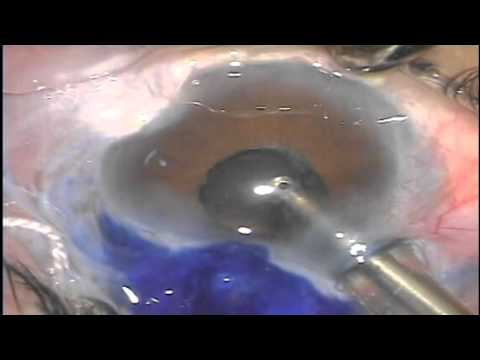 how to dissolve pterygium