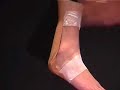 achilles tendon taping achilles tendon taping