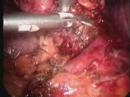 Laparoscopic Right Adrenalectomy