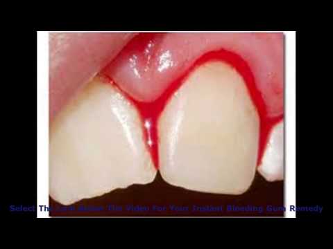 how to make your gums not bleed