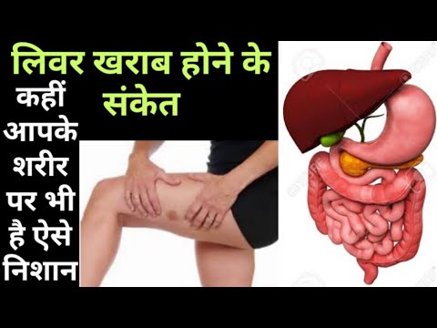 लिवर खराब होने के लक्षण | Liver kharab hone ke lakshan in hindi | Liver kharab hone ke sanket |
