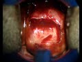 CAF/GINECOLOGY