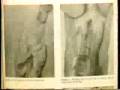 Dr. Dean Edell - Should You Circumcise Her/Him?