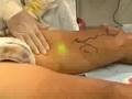 enduminal de varices