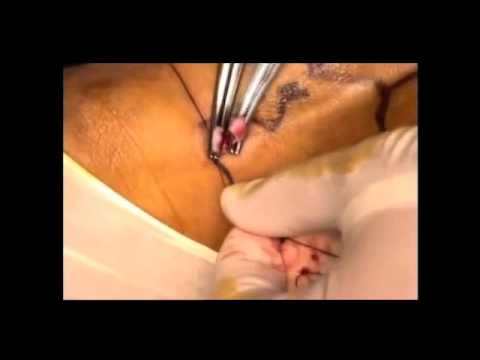 safenectomia - Cirugía realizada por el Dr. Jorge Jarrín Menéndez.