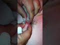 Staph pop